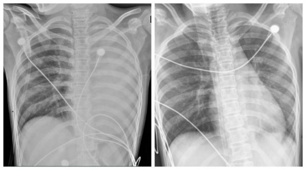 十大股票配资 发热1天左肺全白！这种病可堵塞气道，别误当普通感冒